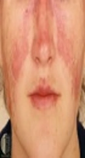 Effects of Interleukin Families Polymorphisms on Systemic Lupus Erythematosus: Focus on Interleukin-1